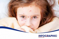 Hà Nội ghi nhận thêm 189 ca mắc sởi trong tuần
